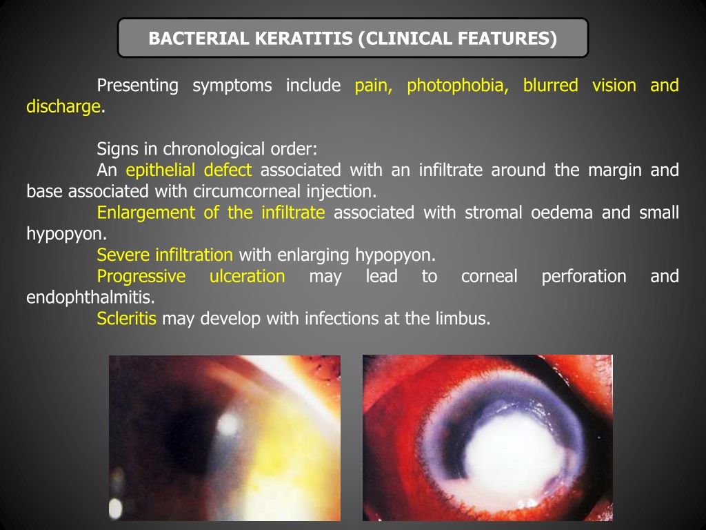 bacterial keratitis symptoms