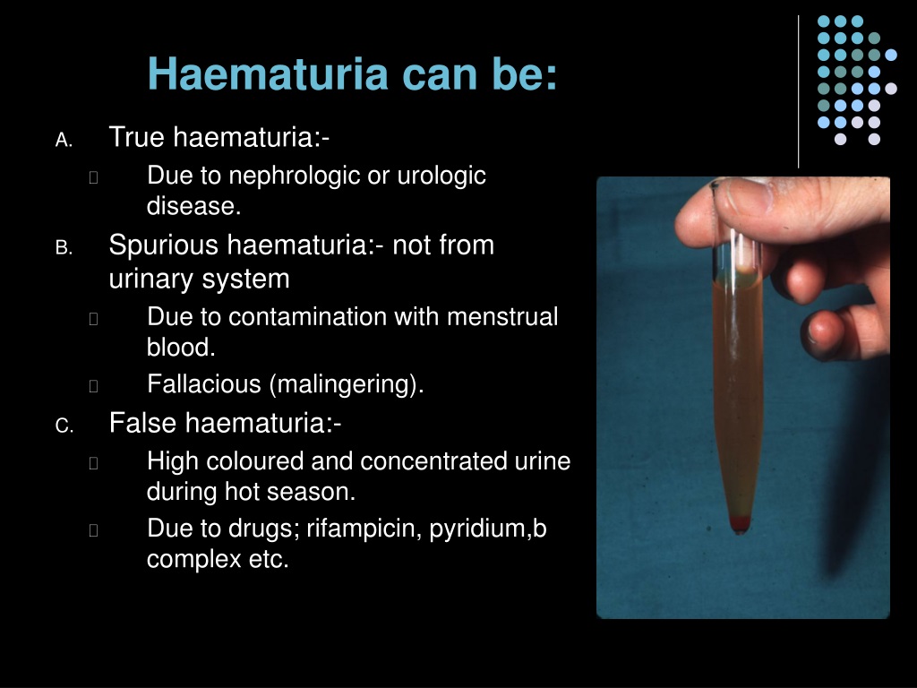 Ppt Causes Of Haematuria Powerpoint Presentation Free Download Id9291519 7068