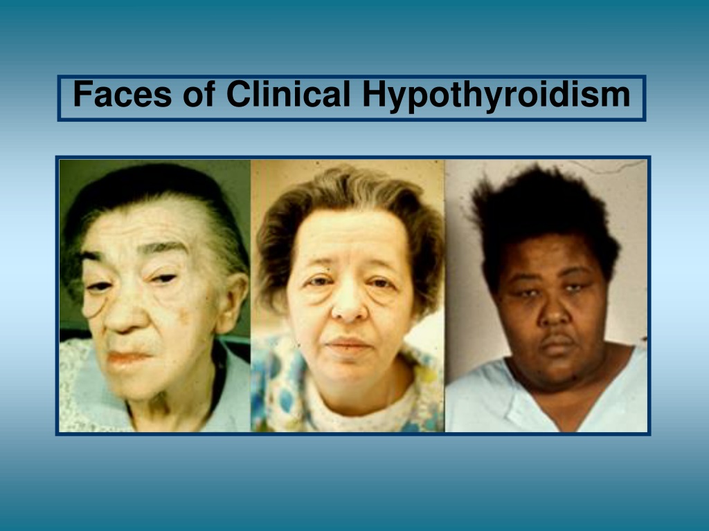 Люди с гипотиреозом. Претибиальная микседема тиреотоксикоз.
