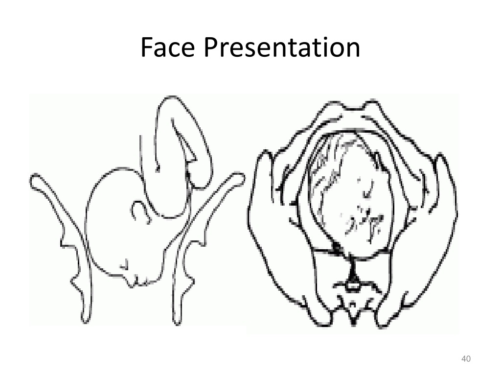 fetal presentation of the face