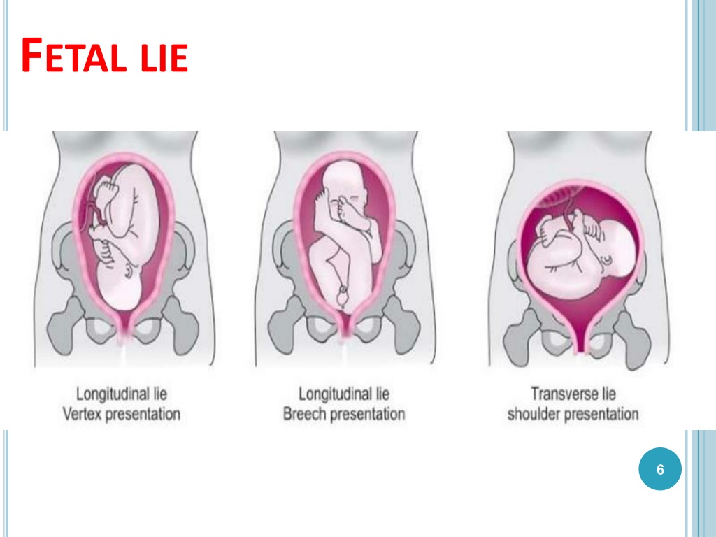 fetal lie is longitudinal with cephalic presentation in hindi