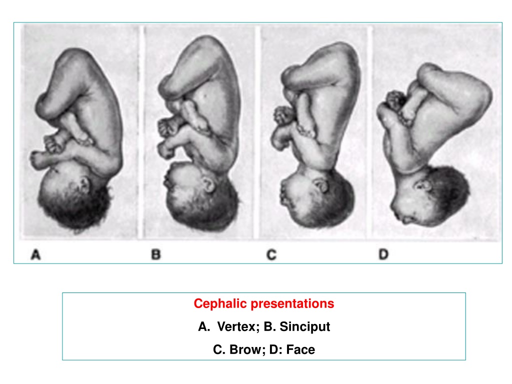 presentation of fetus vertex