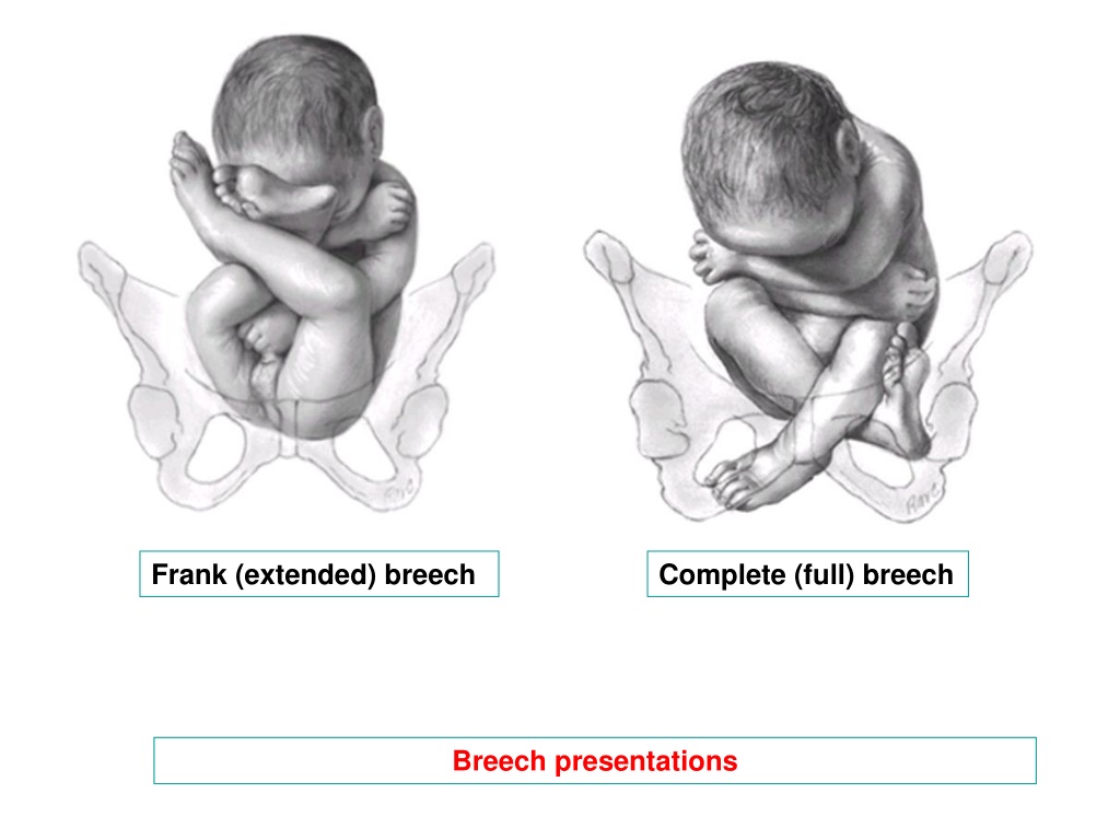 breech presentation vertex