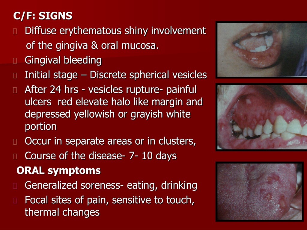 PPT - Gingival and Periodontal Disease PowerPoint Presentation, free ...