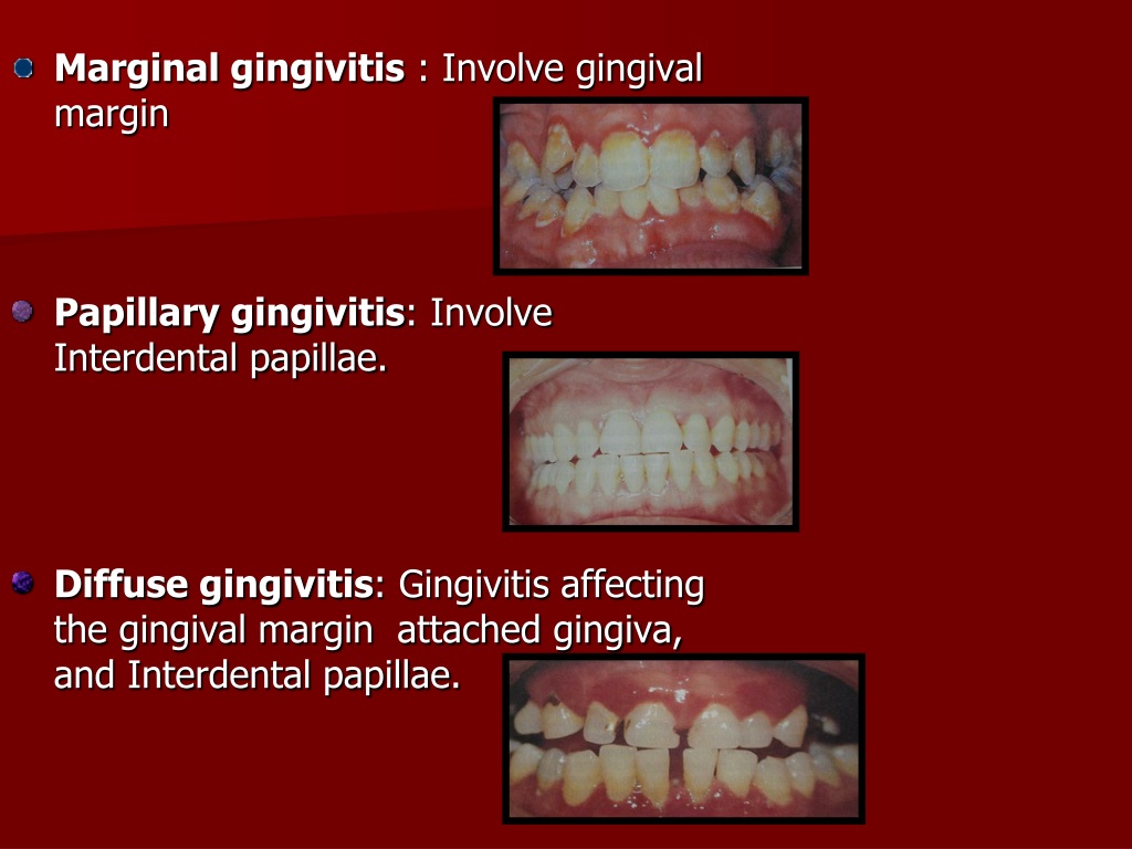 papillary gingiva