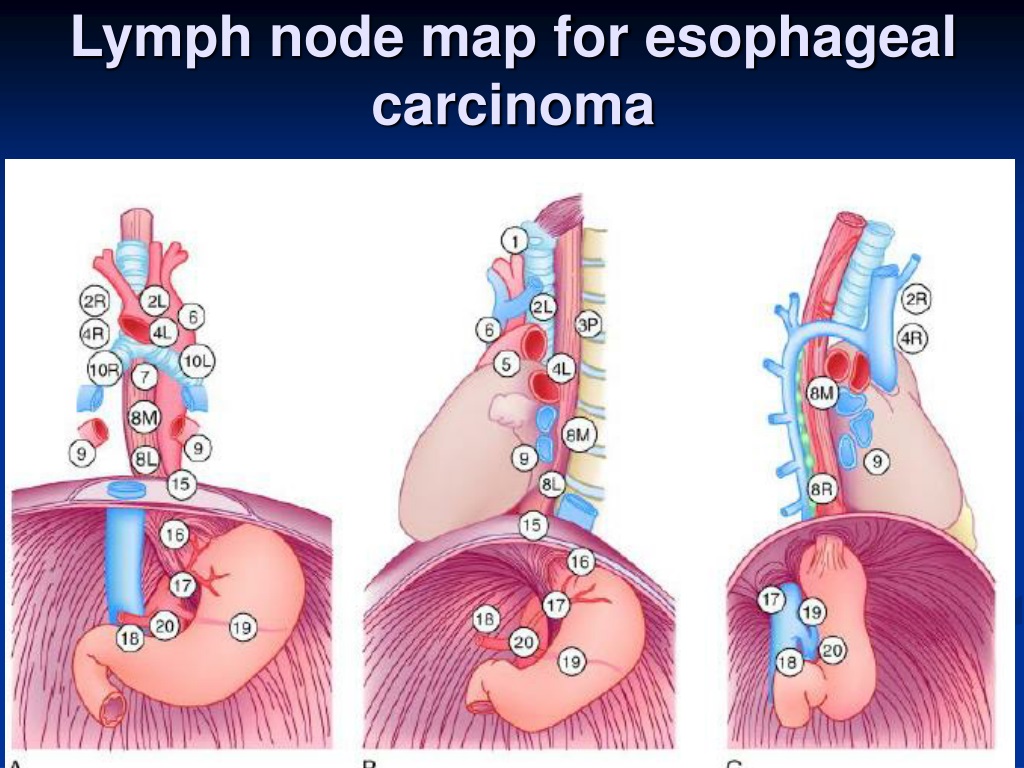 Stage 2 Cancer Lymph Nodes 