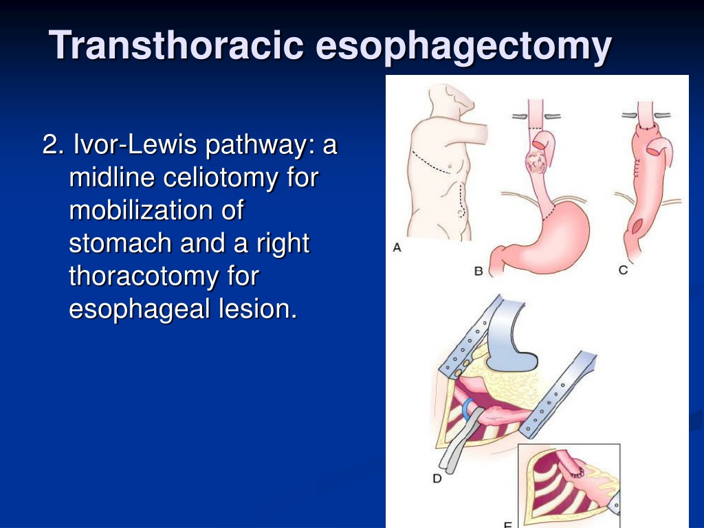 PPT - Esophageal Carcinoma PowerPoint Presentation, Free Download - ID ...