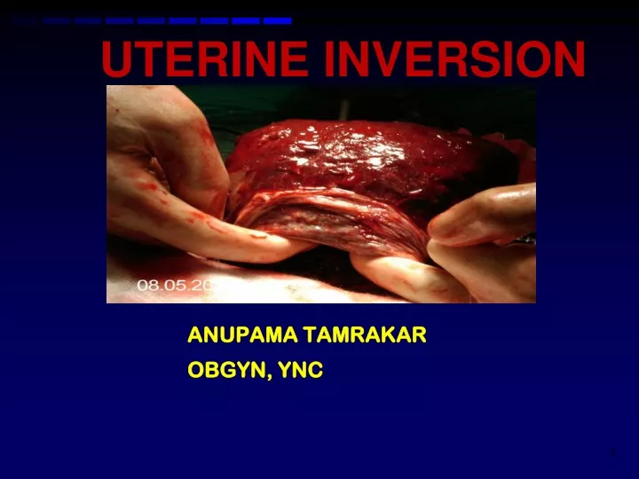 uterine inversion n.