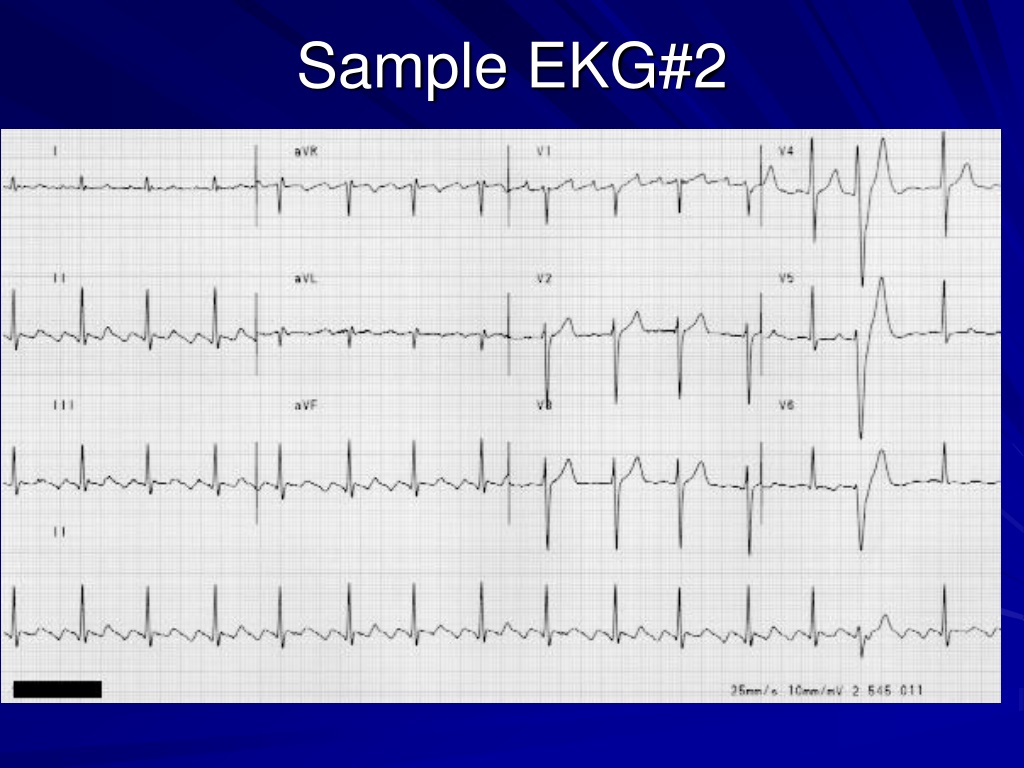 PPT - EKG Basics PowerPoint Presentation, free download - ID:9352430