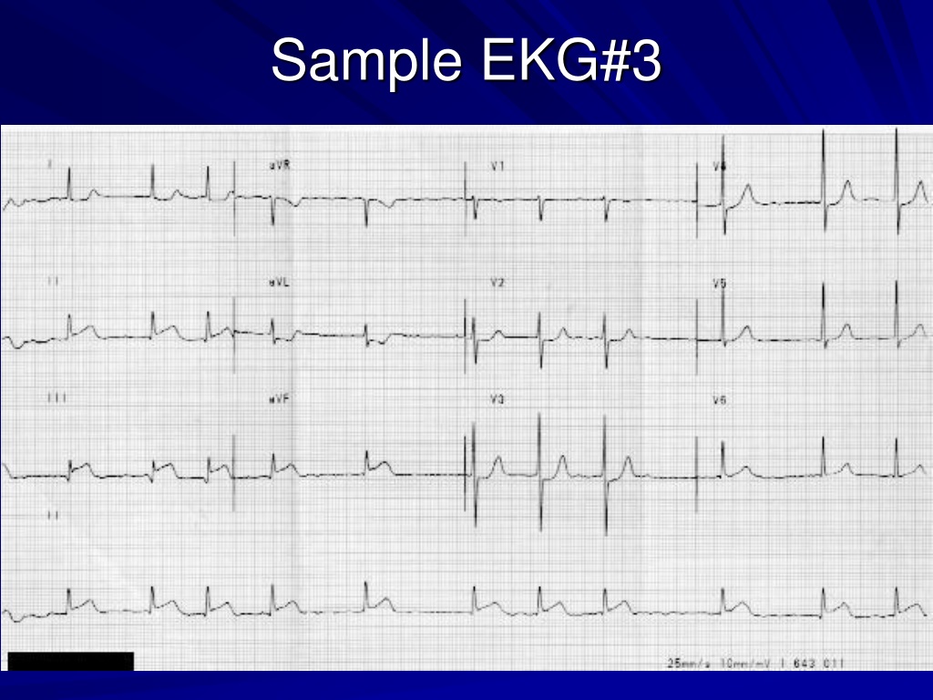 PPT - EKG Basics PowerPoint Presentation, free download - ID:9352430