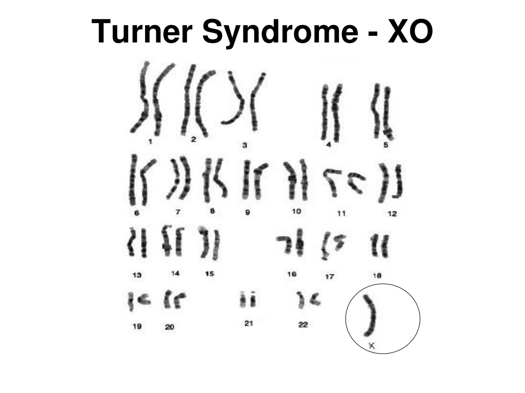 xo karyotype