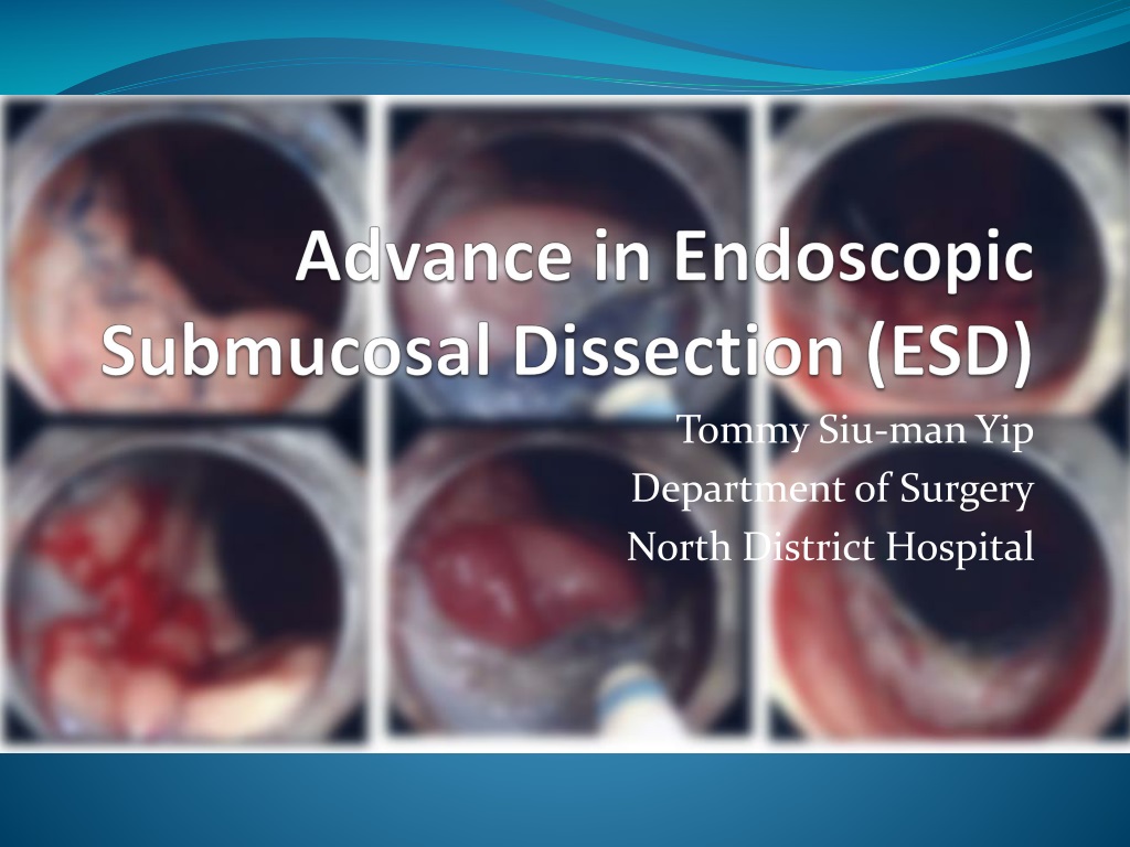 PPT - Advance In Endoscopic Submucosal Dissection (ESD) PowerPoint ...