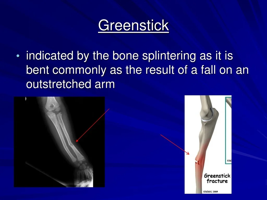 PPT Fractures Wounds PowerPoint Presentation Free Download ID 