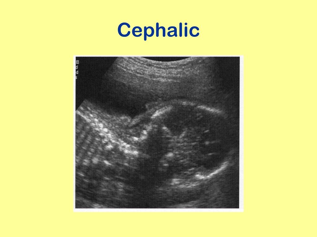 ultrasound presentation cephalic