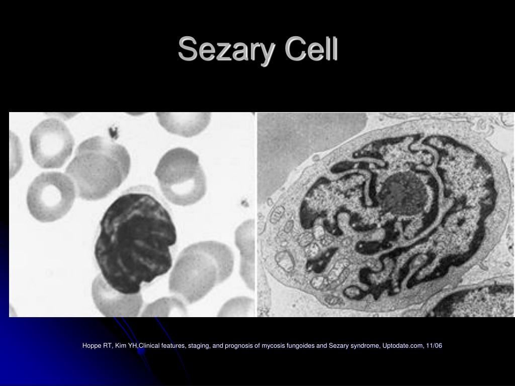 Ppt Mycosis Fungoides And Sezary Syndrome Powerpoint Presentation