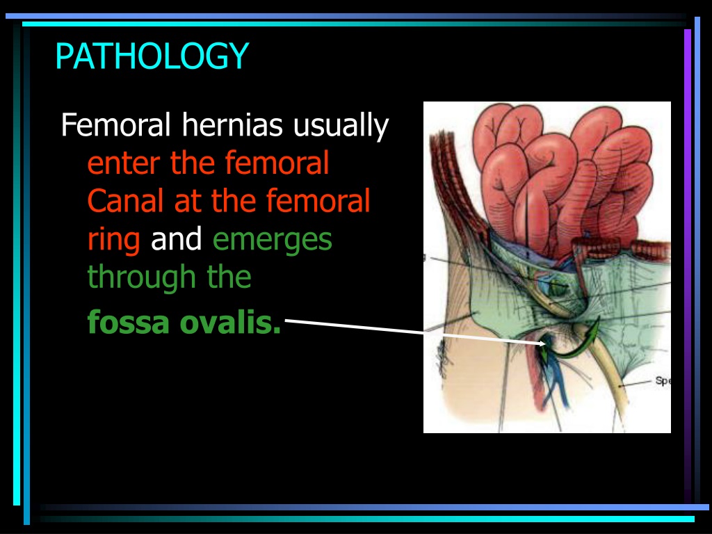 what is a femoral hernia
