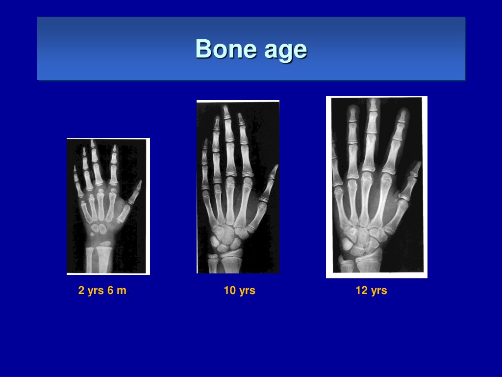 Age studies. Bone age. X-ray Exam: Bone age study. Bone age в Тольятти. Vicente Gilsanz · Osman Ratib hand Bone age.