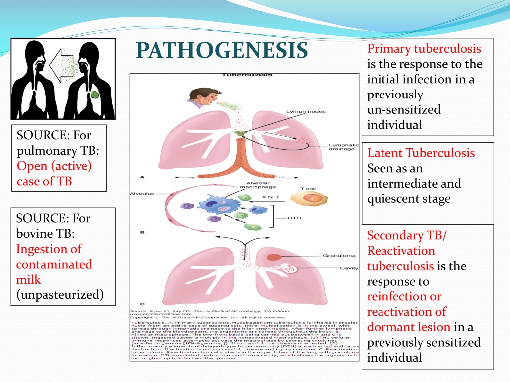 Ppt Lrti Part 5 Tuberculosis Powerpoint Presentation Free Download