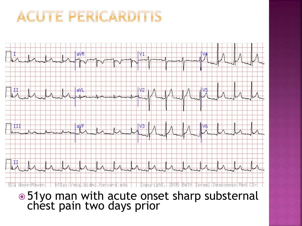 PPT - Acute Pericarditis Pericardial Effusion Tamponade PowerPoint ...