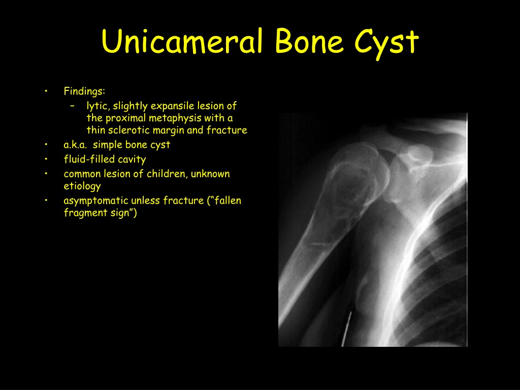 Ppt Aneurysmal Bone Cyst Powerpoint Presentation Free Download Id9481694 7664