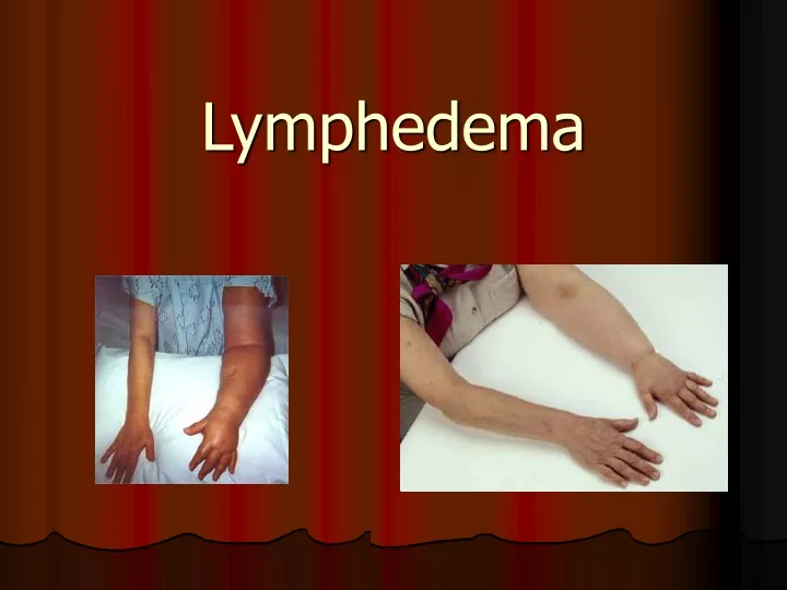 PPT - Lymphedema PowerPoint Presentation, free download - ID:9499712