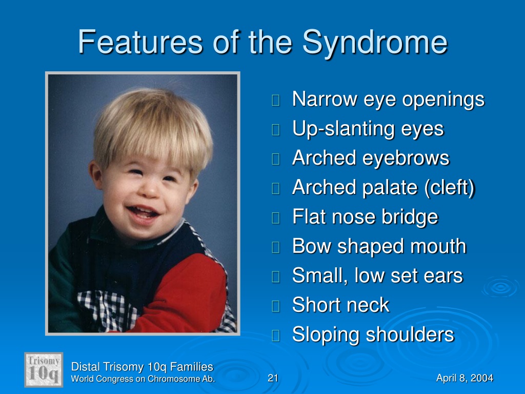 PPT - An Overview of Distal Trisomy 10q PowerPoint Presentation, free ...