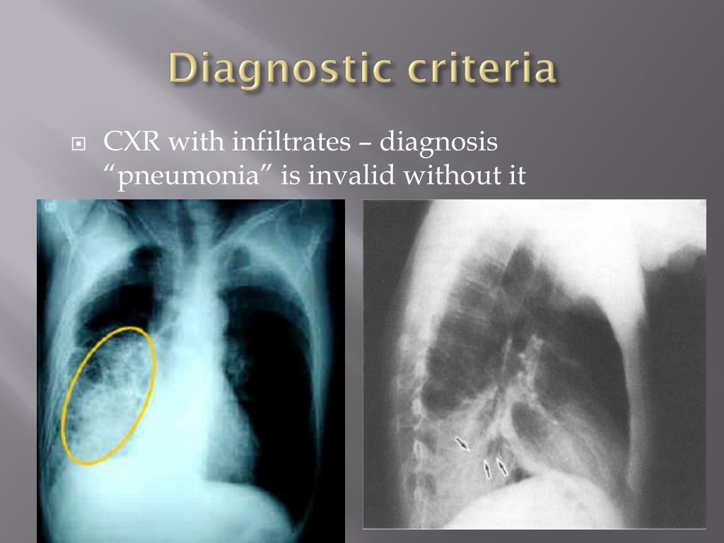 PPT - Pneumonia PowerPoint Presentation, free download - ID:9522430