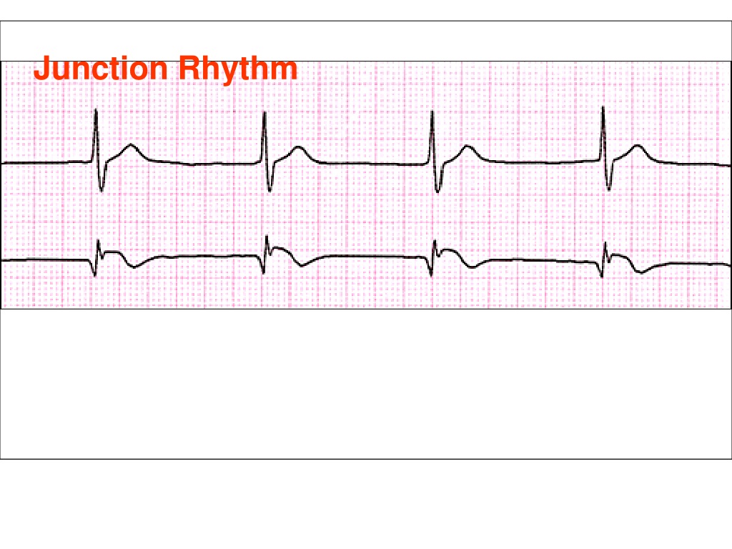 PPT - ECG INTERPRETATION PowerPoint Presentation, Free Download - ID ...