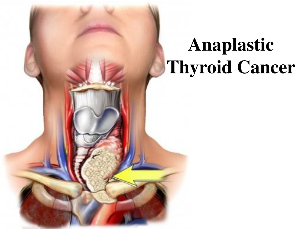 Аплазия щитовидной железы. Аплазия доли щитовидной железы. Гипоплазия щитовидной железы УЗИ.