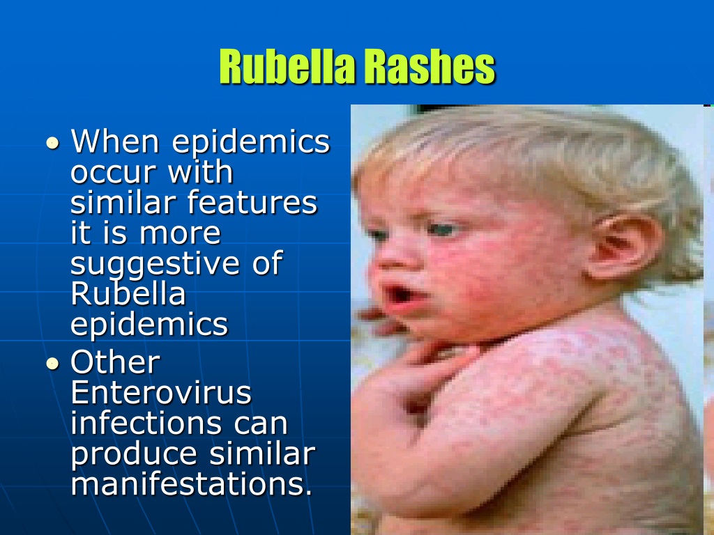 PPT - RUBELLA PowerPoint Presentation, free download - ID:9525270