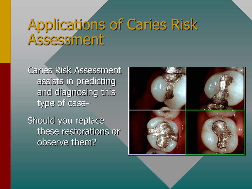 Ppt Caries Risk Assessment And Its Interaction With Preventive And Restorative Protocols 0299