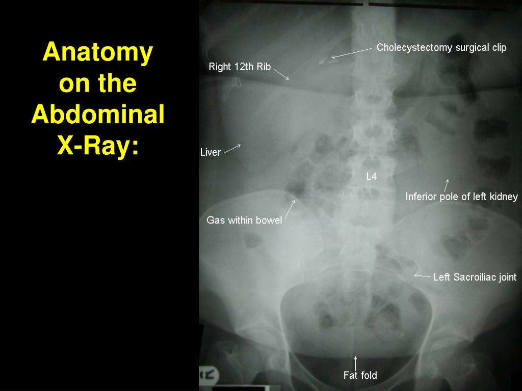 abdominal x ray powerpoint presentation