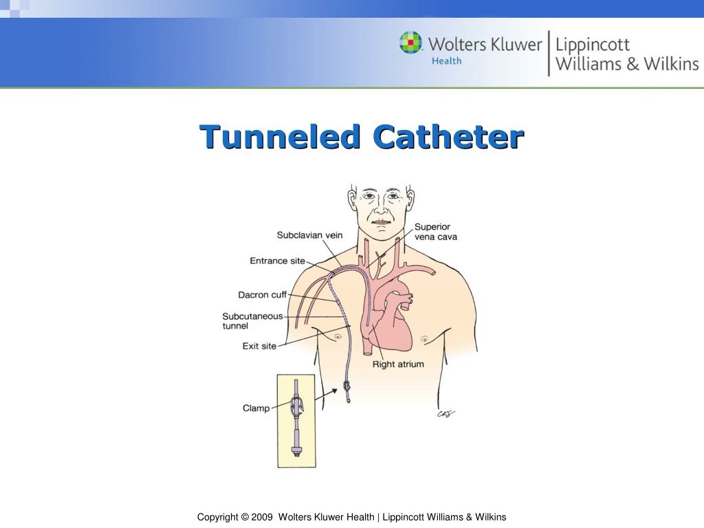 Tunneled Central Venous Catheter Placement