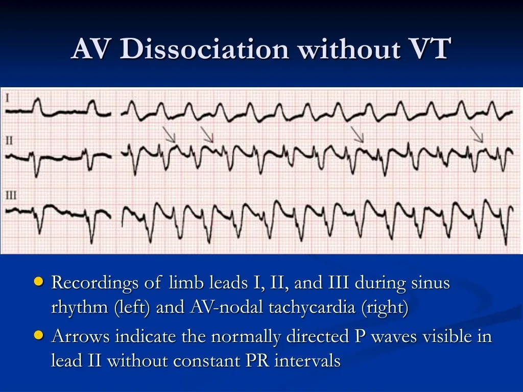 PPT Comprehensive Guide To Ventricular Tachycardia Diagnosis PPT Comprehensive Guide To Ventricular Tachycardia Diagnosis