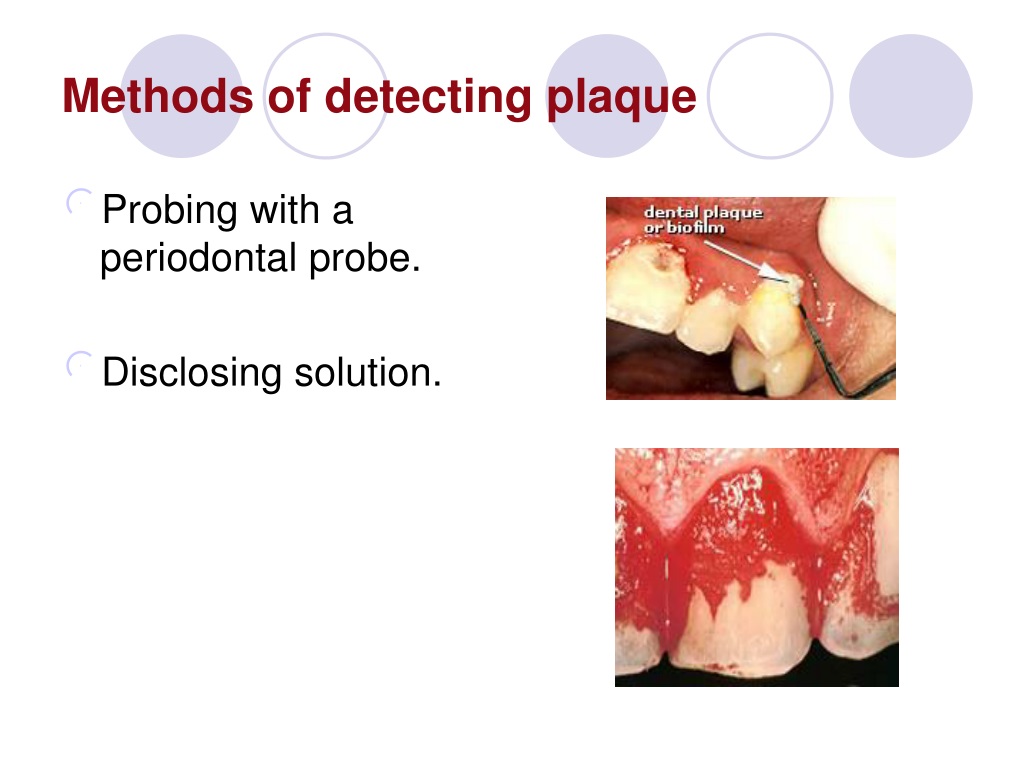 Ppt Dental Plaque Powerpoint Presentation Free Download Id9596205