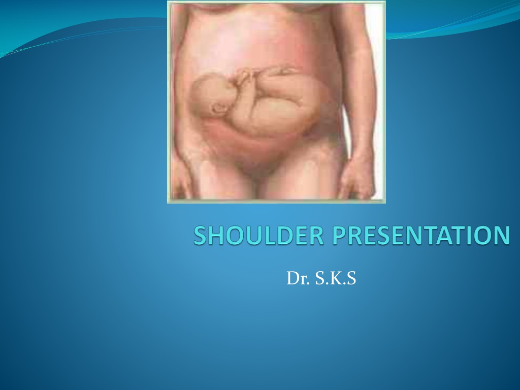 shoulder presentation means