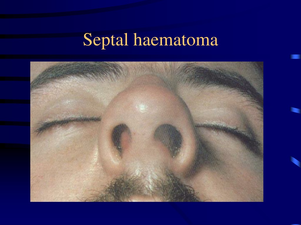 PPT Nasal Obstruction PowerPoint Presentation Free Download ID