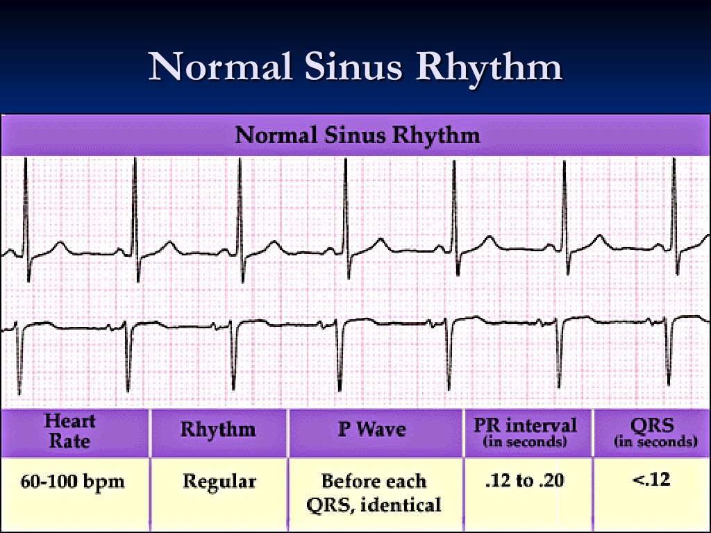 a-example-of-normal-sinus-rhythm-b-example-of-atrial-fibrillation