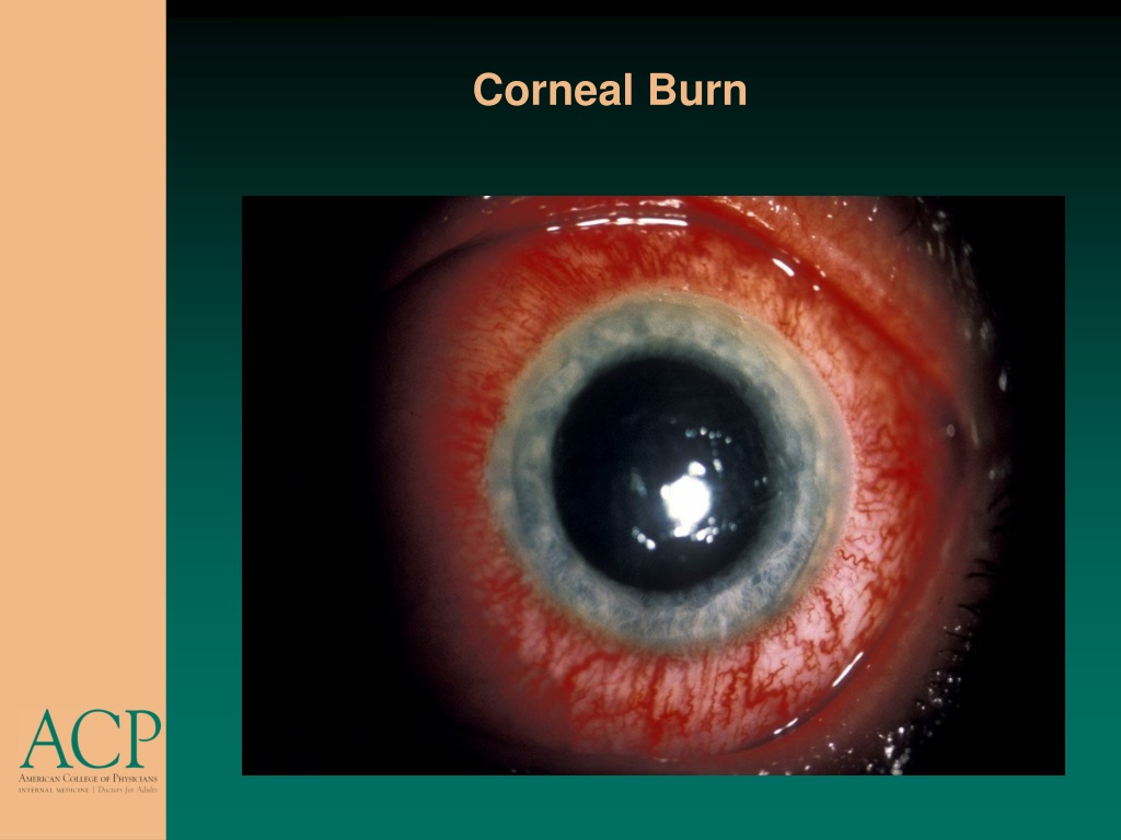 PPT - Corneal Abrasion PowerPoint Presentation, Free Download - ID:9633458