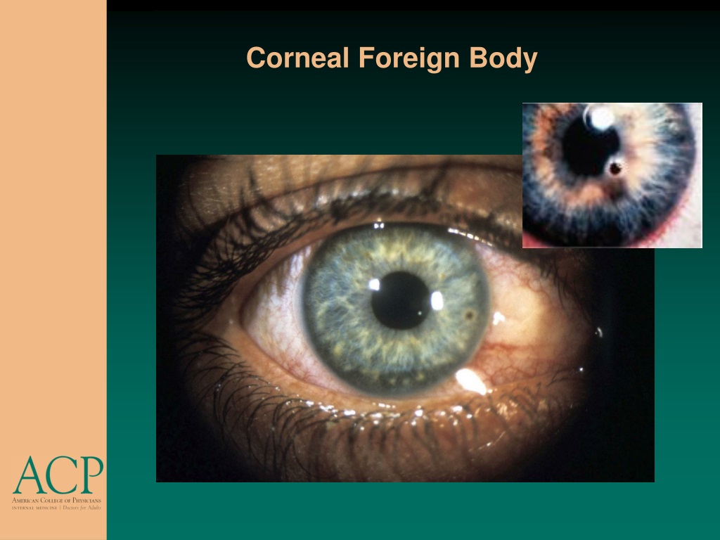 PPT - Corneal Abrasion PowerPoint Presentation, Free Download - ID:9633458