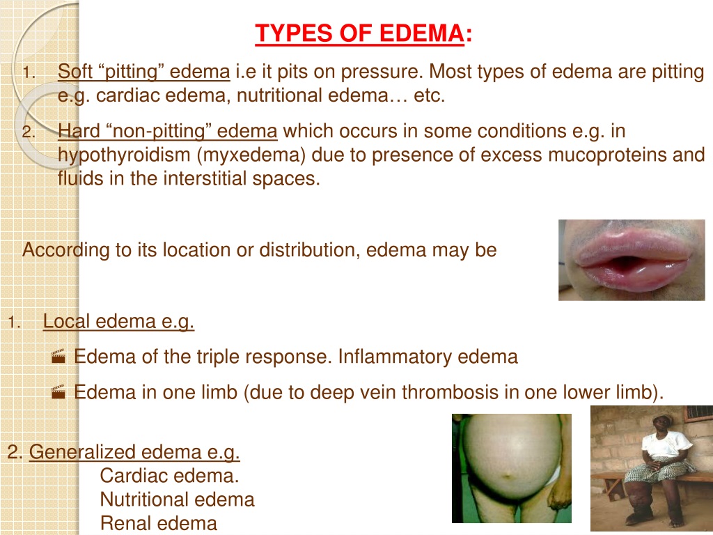 ppt-interstitial-fluid-formation-and-oedema-by-dr-qazi-imtiaz-rasool