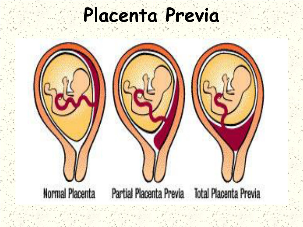 PPT - Complications of Pregnancy PowerPoint Presentation ...