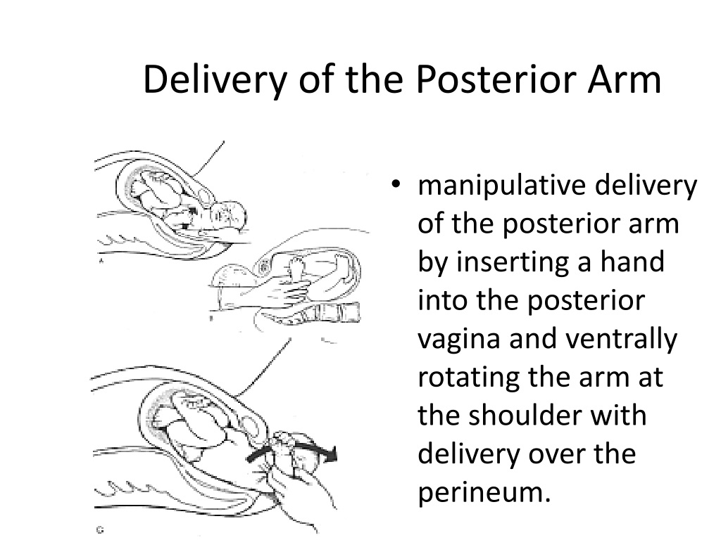 PPT Shoulder Dystocia PowerPoint Presentation, free download ID9653346