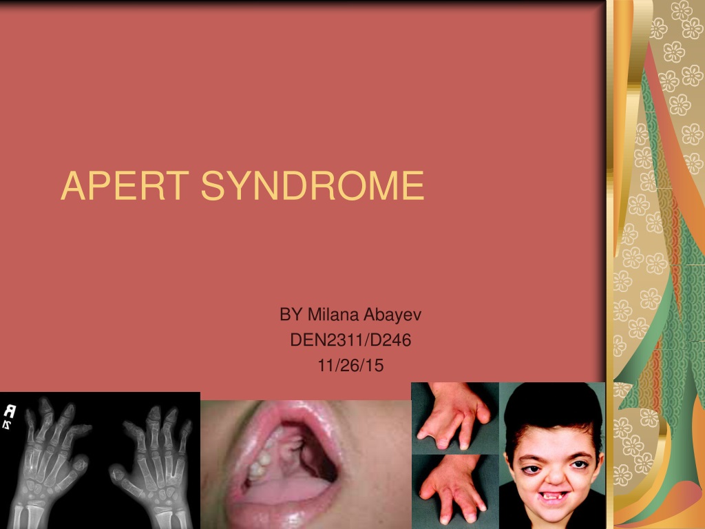 PPT - APERT SYNDROME PowerPoint Presentation, free download - ID:9653738
