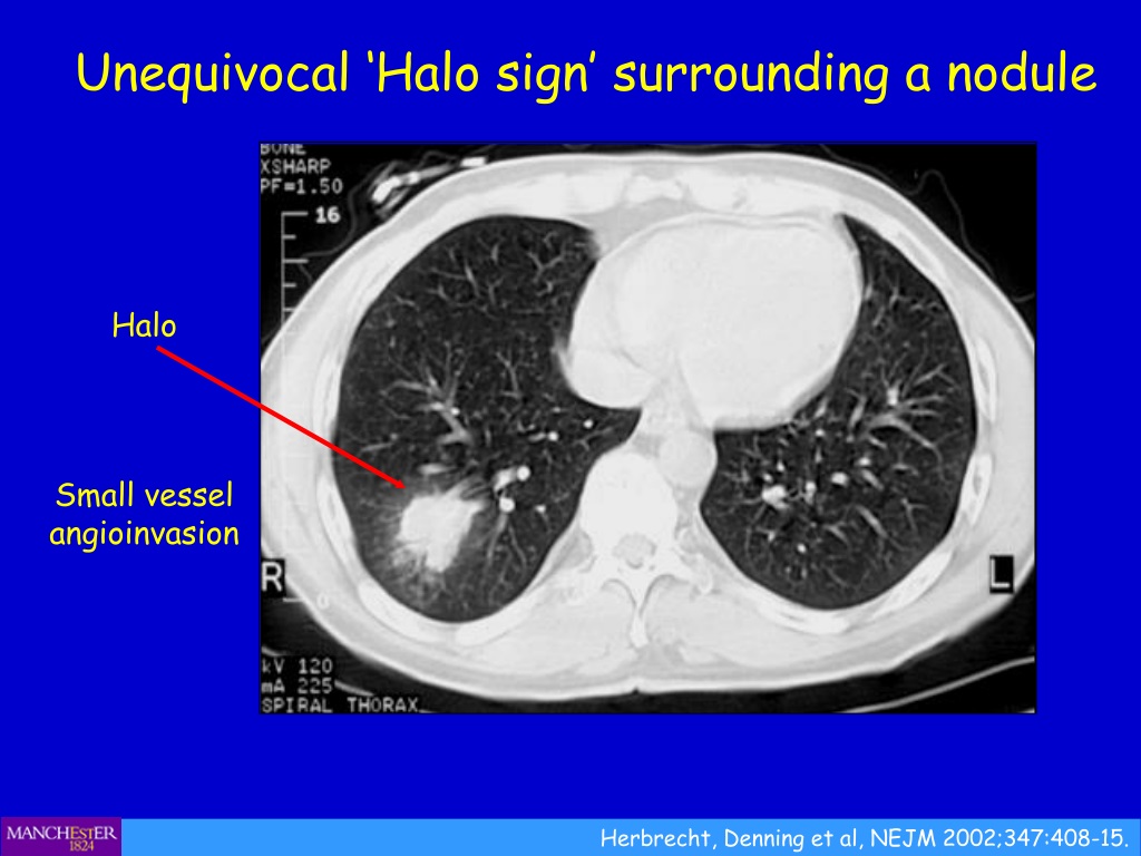 PPT - Diagnosis Of Pulmonary Aspergillosis (ignoring Allergy ...