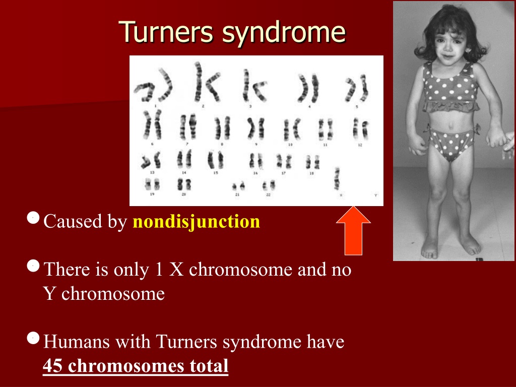 Синдром тернера какая хромосома. Шерешевский Тернер набор хромосом. Синдром Шерешевского Тернера набор хромосом. Болезнь Шерешевского-Тернера синдром Клайнфельтера. Синдром Тернера кариотип.