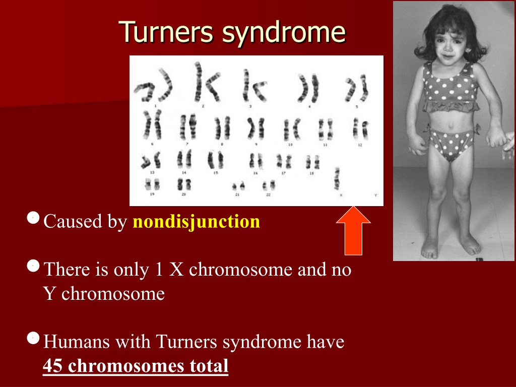 Шеришевского тернера. Синдром Шерешевского Тернера набор хромосом. 45 Хромосом синдром Тернера. Болезнь Шерешевского-Тернера синдром Клайнфельтера. Синдром Тернера кариотип.