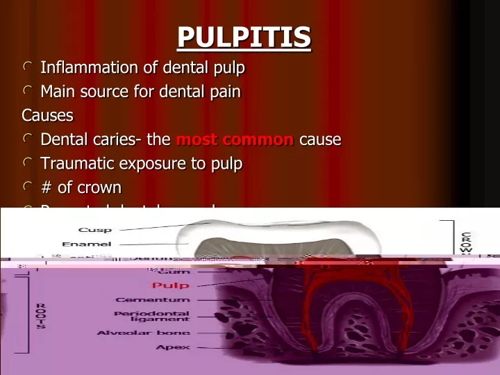 pulpitis inflammation of dental pulp main source n.
