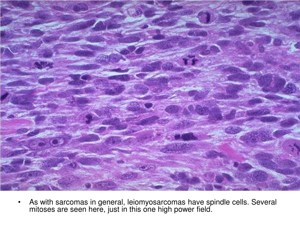 Лейомиосаркома. Лейомиосаркома желудка гистология. Лейомиосаркома матки гистология. Лейомиосаркома патанатомия. Лейомиома желудка гистология.