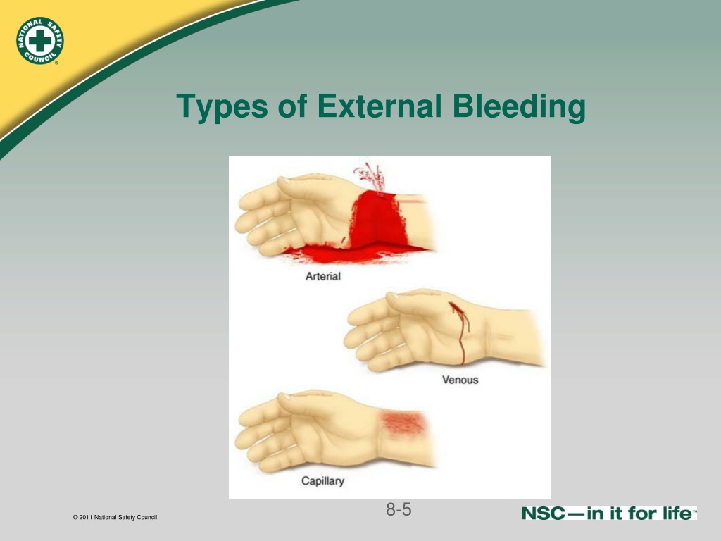 PPT - CONTROLLING BLEEDING PowerPoint Presentation, free download - ID ...